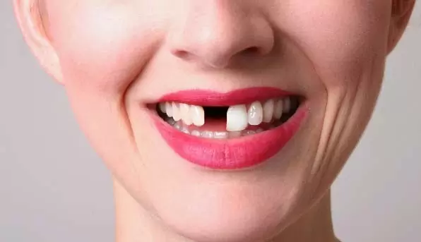 Solusi Mengatasi Gigi Ompong di Usia Muda